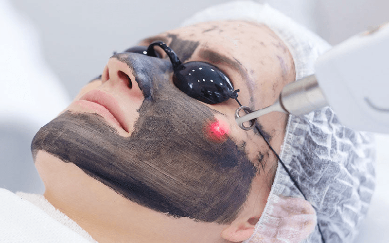 Hollywood Peel